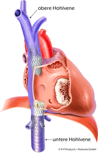 Herz_TricValve
